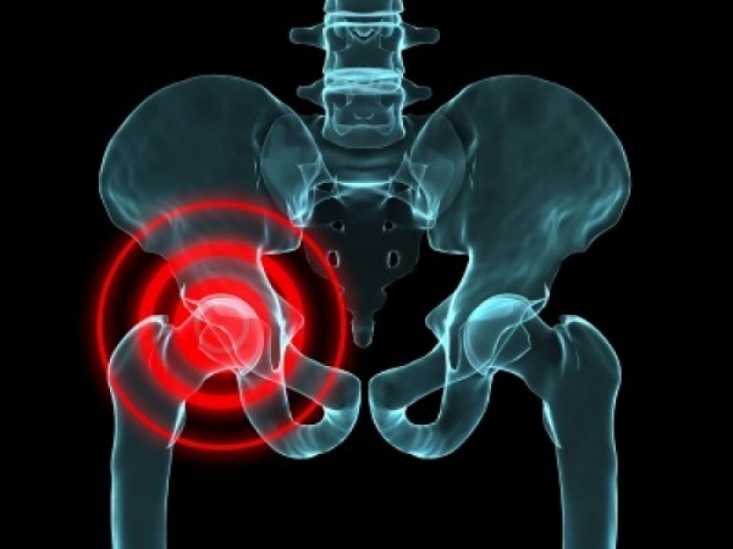 Xray image of hip and a marker indicating frequent area of pain.